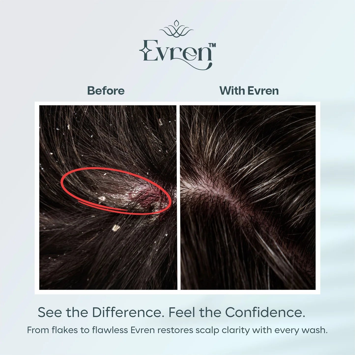 Before and after comparison of scalp with Evren product showing flake reduction