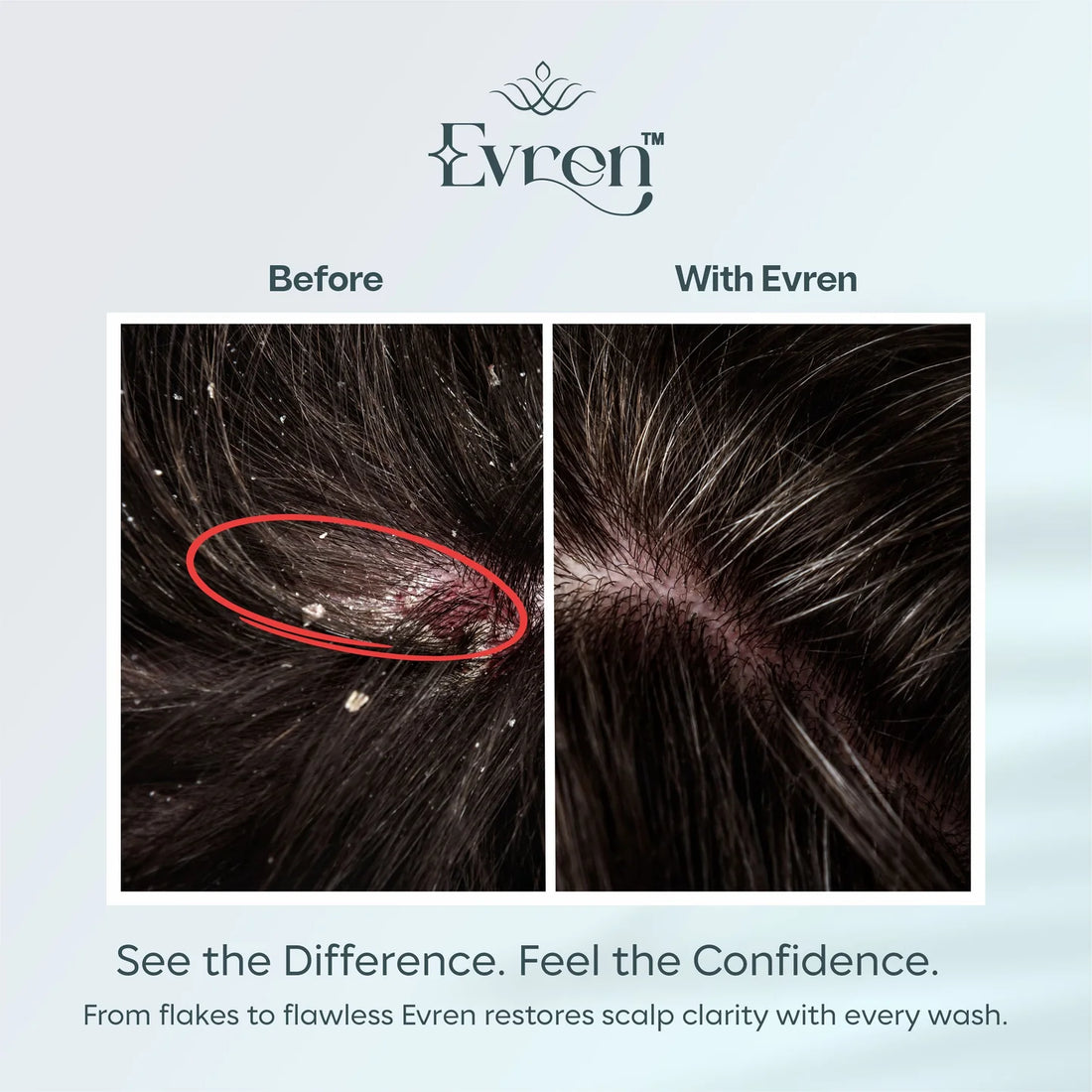 Before and after comparison of scalp with Evren product showing flake reduction