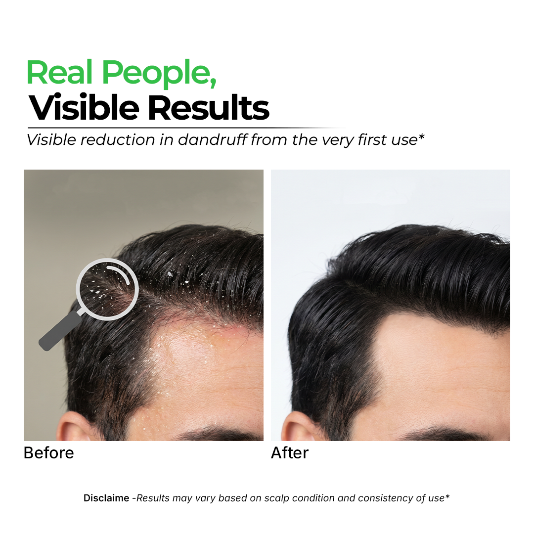 Evren Anti-Dandruff Combo benefits — dandruff control in one kit