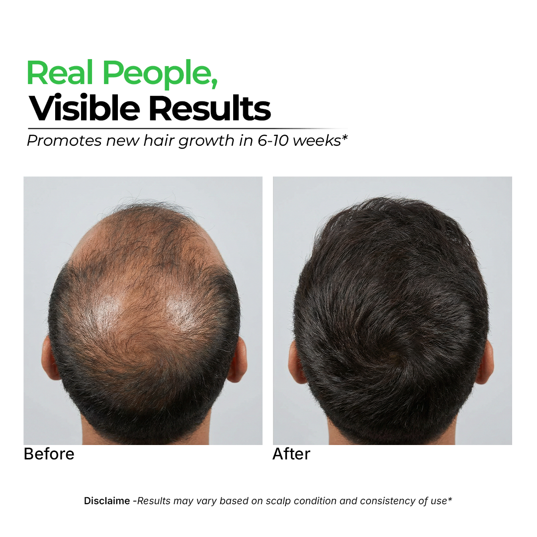 Real customer photo using Evren Hair Growth Products